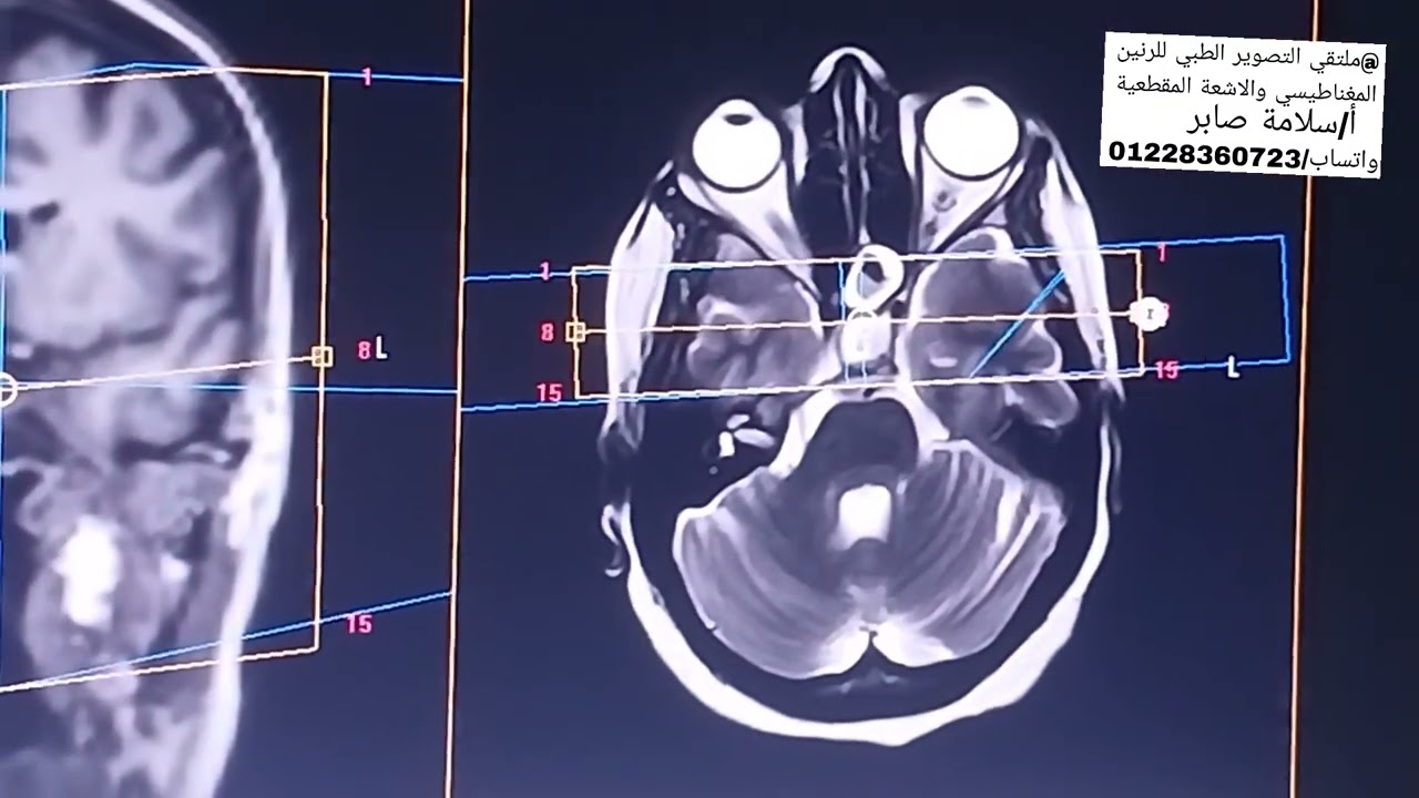 رنين مغناطيسي علي الغده النخاميه #MRI_SELLA علي جهاز فيلبس 1.5 تسلا الاشتراك في القناه وتفعيل الجرس