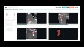 Mandibular Condyle Segmentation on CBCT: AI Demo