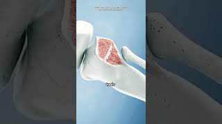 Tibia Fracture Surgery (3D Animation)