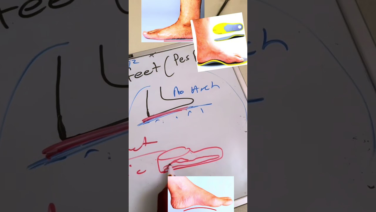 Flat Foot- Musawo Aine 