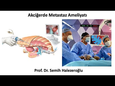 Akciğer Metastazı Ameliyatı
