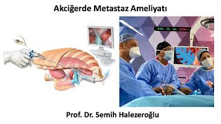 Akciğer Metastazı Ameliyatı