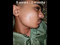 My minoxidil 5 journey