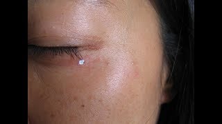 How To Remove Individual Syringoma Wart Mole Vanish