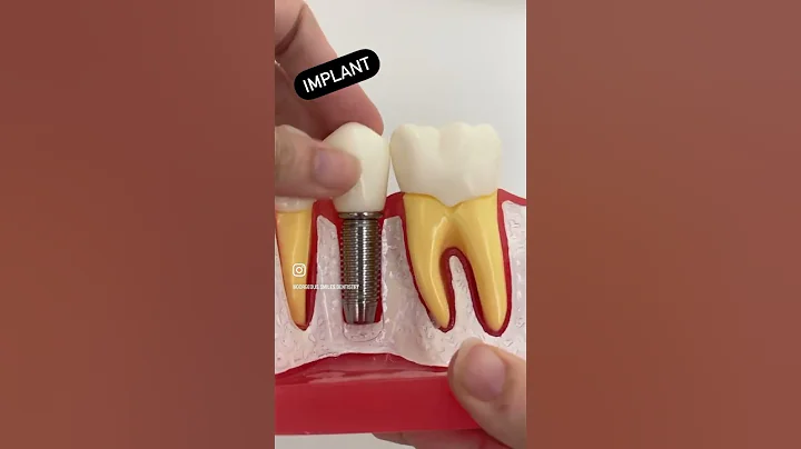 How To Replace A Missing Tooth?