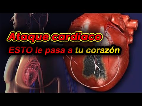 Si tienes <strong>ESTO</strong>, puede ser que &amp;<strong>quot</strong>;es 1 señal de Ataque cardiaco&amp;<strong>quot</strong>;