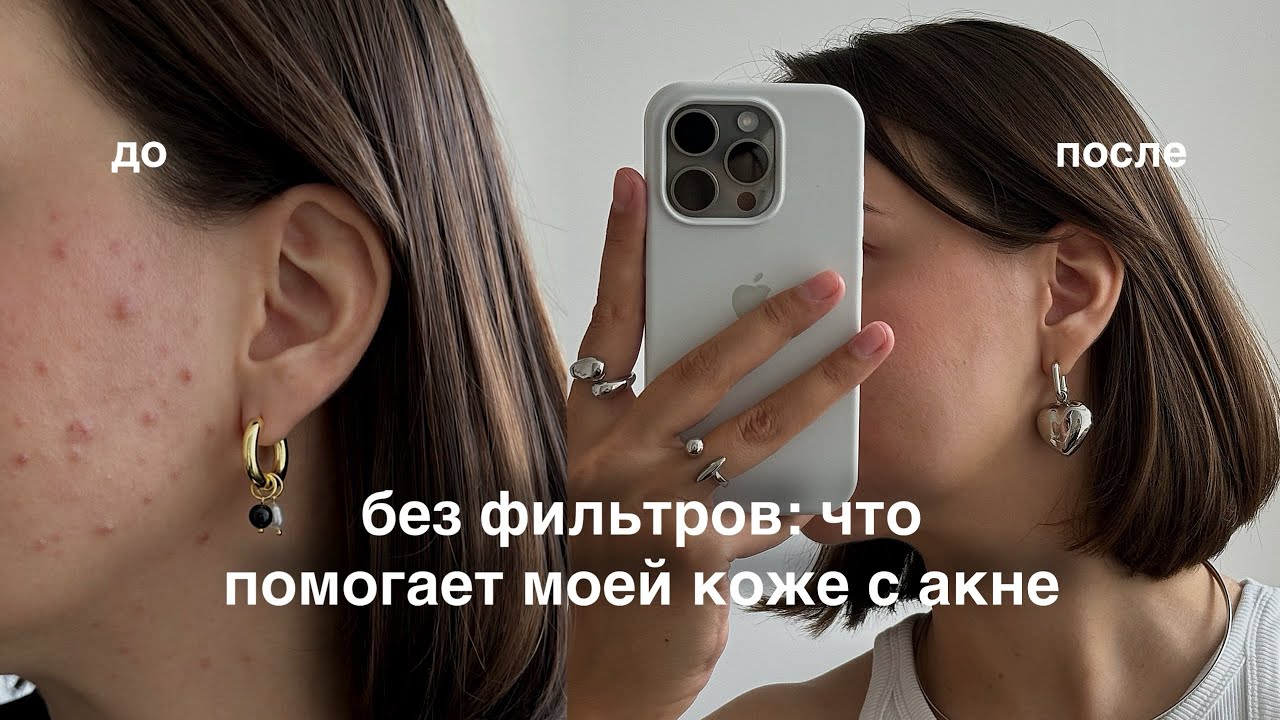 УХОД ДЛЯ ИДЕАЛЬНОЙ КОЖИ | мой прайм после 13 лет акне