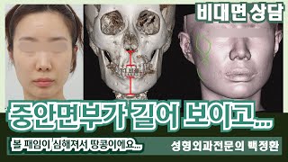중안면부가 길어 보이고 볼 패임이 심해져서 땅콩이에요. [비대면상담 557] / so it looks like a peanut.