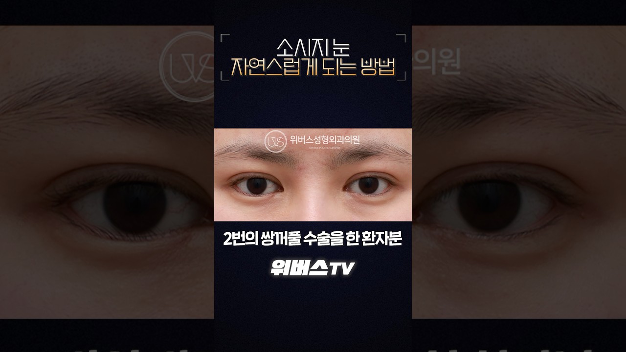 [Вэвэрс Гоо Сайхны Клиник] Сосиска мэт нүдийг байгалийн болгох мэс заслын арга 👀⭐