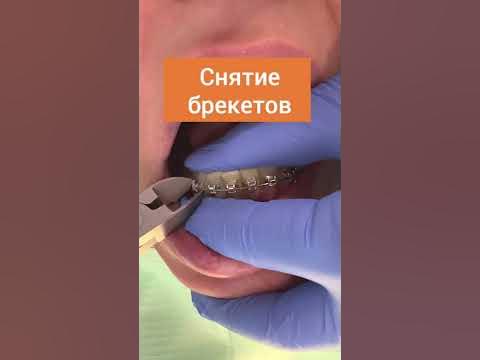 Снятие брекетов - YouTube