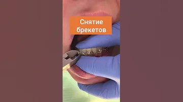 Снятие брекетов