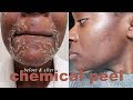 Chemical Peel for Dark Spots, Acne & Large Pores | Before & After Results!