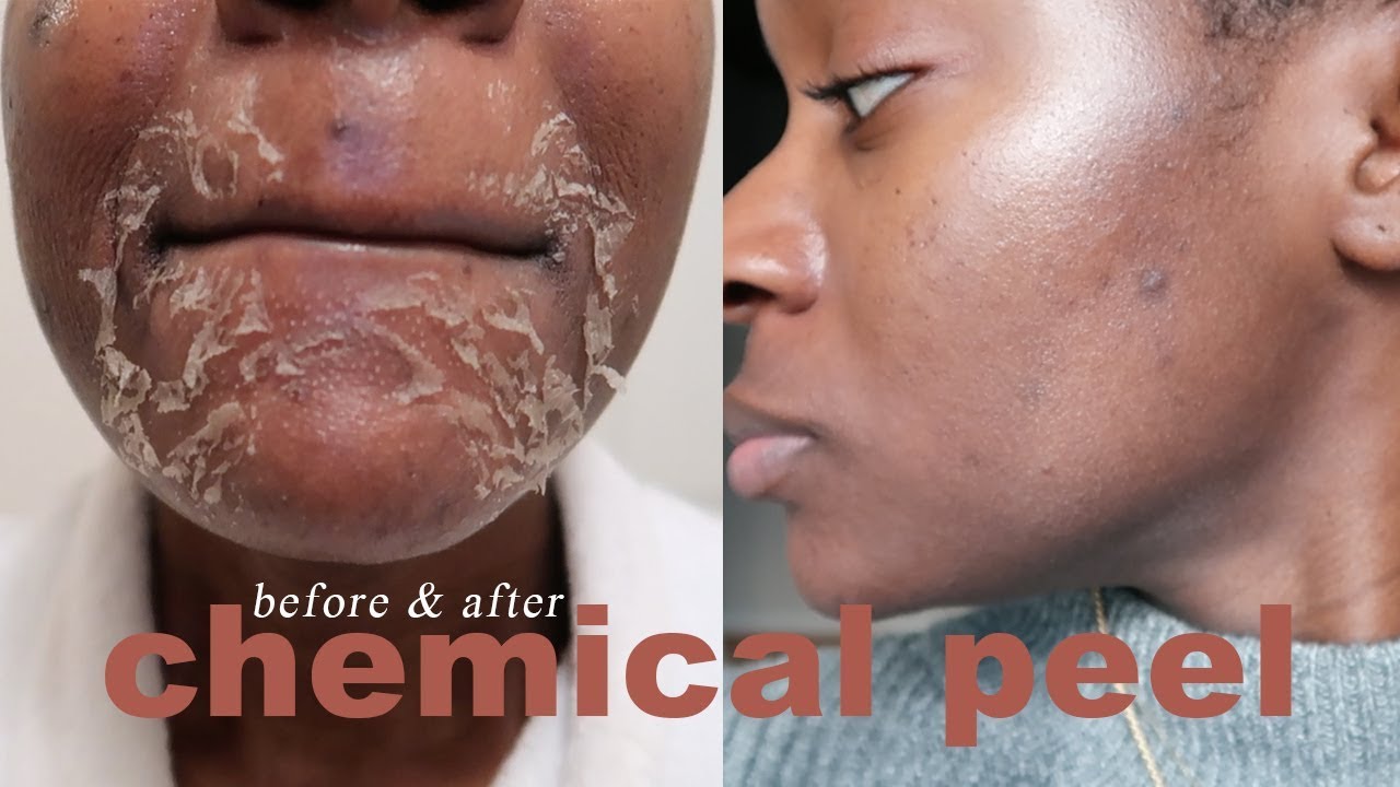 I Tried A Chemical Peel! | Full Process, Before And After Dark Marks & Acne  Scars - Youtube