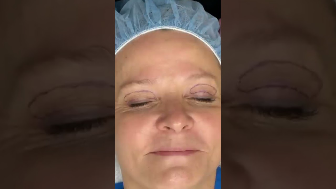 Upper Blepharoplasty: Surgical Eyelid Crease Explained!
