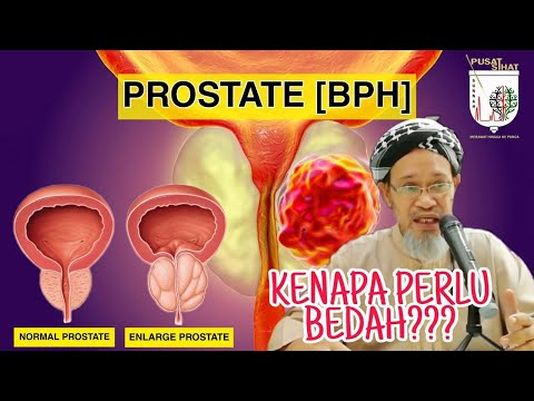 Video: Apakah Pilihan Rawatan Anda Untuk Prostat Yang Membesar?