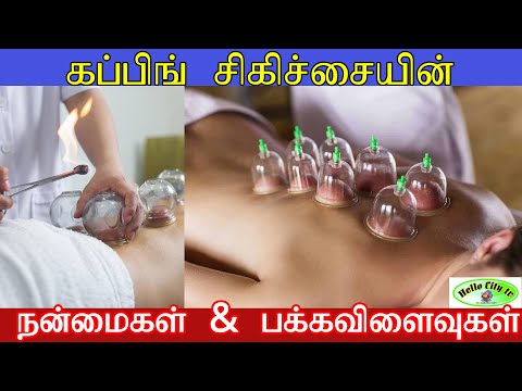 கப்பிங் சிகிச்சையின் நன்மைகள் மற்றும் பக்கவிளைவுகள் |  cupping therapy side effects | Hello City Tv