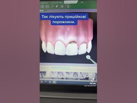 Пришеечная полость в зубе.Клиновидный деффект. - YouTube