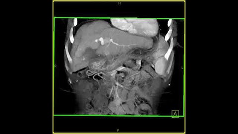 Abdomen: Liver: Cirrhosis: 3D: Volume rendering of a cirrhotic liver with collaterals