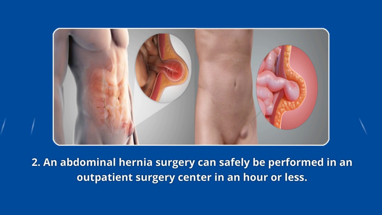 3 Things You Need To Know About Abdominal Hernia Surgery Youtube