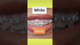 5 worst braces colors to get #shorts #bracescolors #dentalhygienist #braces