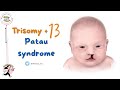   متلازمة باتاو 13