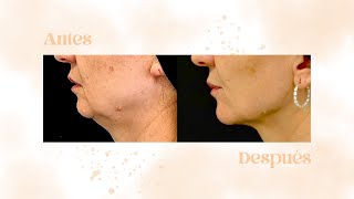 Rejuvenecimiento de cuello sin cirugía: FaceTite, Morpheus8 y Lifting líquido