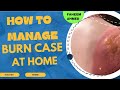 How to manage Burn Case At Home During Cooking #burn