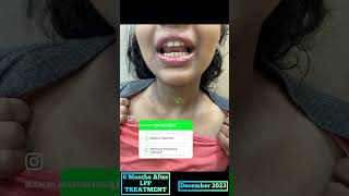 Progress of Lichen Planus Pigmentosus Treatment | Dr Ashima Goel | MD Dermatologist in Chandigarh