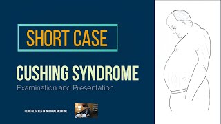 Cushing Syndrome (Short Case)