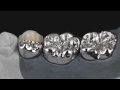 Ceramill sintron  la rivoluzione per le leghe non preziose