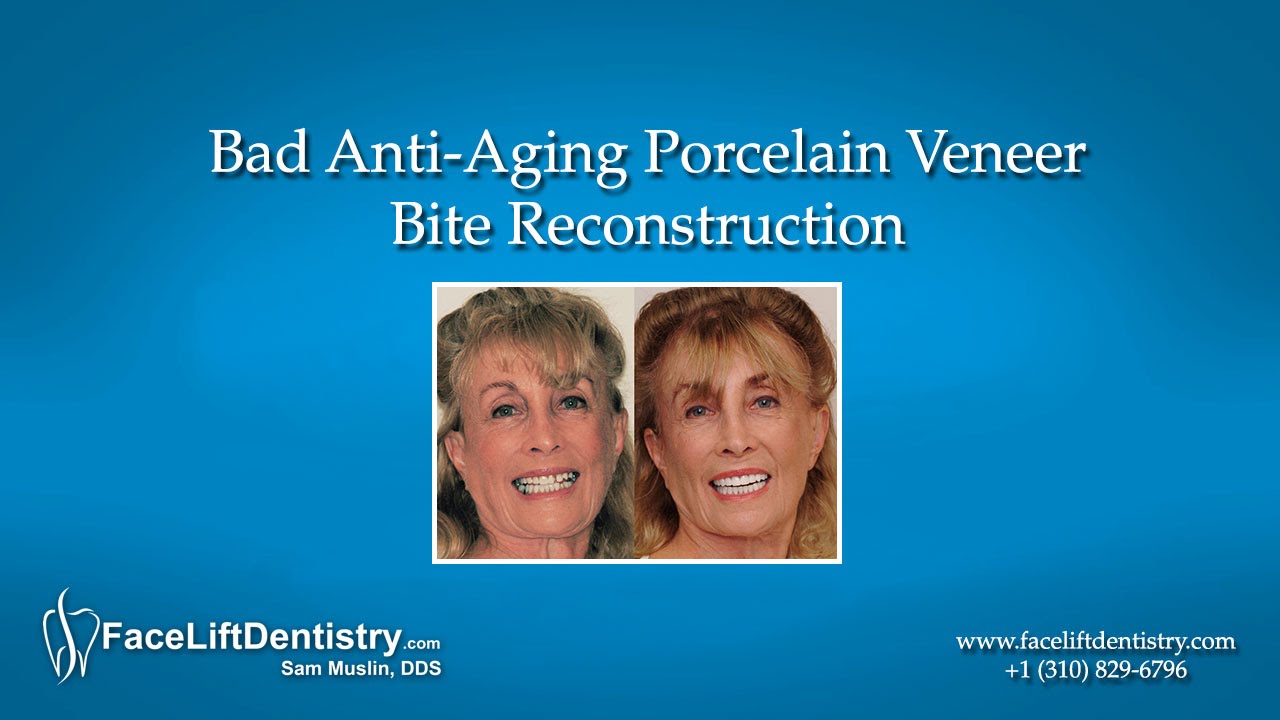 Bad Anti-Aging Porcelain Veneer Bite Reconstruction smile makeover cost in pakistan