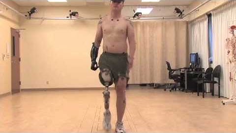 Gait Analysis of a Man in Military Who Was Injured by an IED in Afghanistan