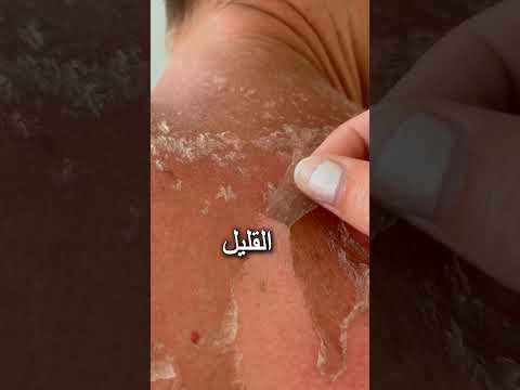 كيفية التخلص من حروق الشمس شورت اكسبلور اللعبه قصص كيفيه ترند 