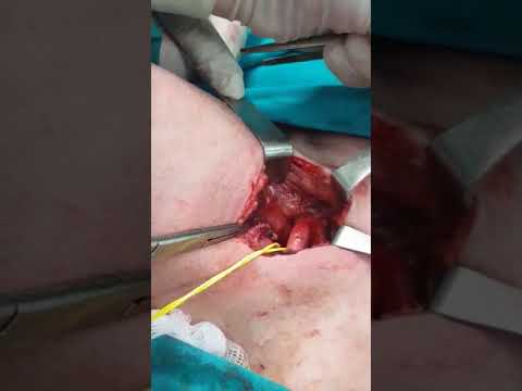 Βίντεο: Επιλεκτική χειρουργική επέμβαση: Θα έπρεπε ή δεν πρέπει