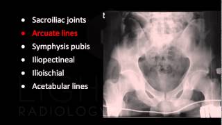 Emergency X-Ray Interpretation of the Pelvis screenshot 5