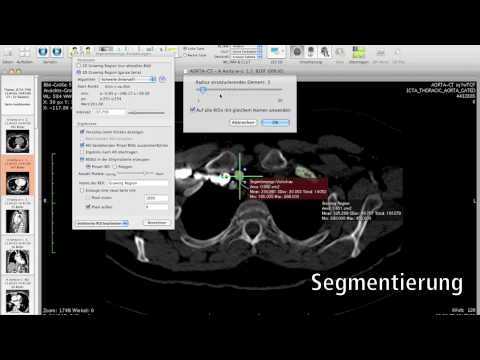 Video: Nützlichkeit Virtueller Monoenergetischer Bilder Aus Der Spektraldetektor-Computertomographie Zur Verbesserung Der Bildsegmentierung Für 3D-Druck- Und Modellierungszwecke