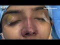 Revision Cosmetic Rhinoplasty - First Nose Surgery done at Bangalore by Plastic Surgeon