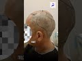 ОТЗЫВ КЛИЕНТА IHAIRIUM О ПЕРЕСАДКЕ ВОЛОС В ТУРЦИИ #пересадкаволос #turkeyhairclinic
