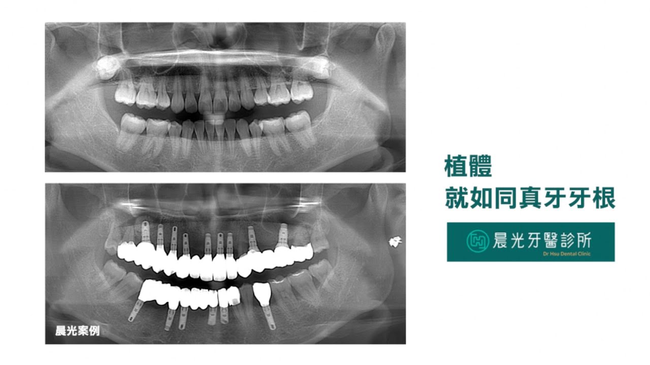 晨光影片|植牙成功的關鍵因素是…? 縮圖