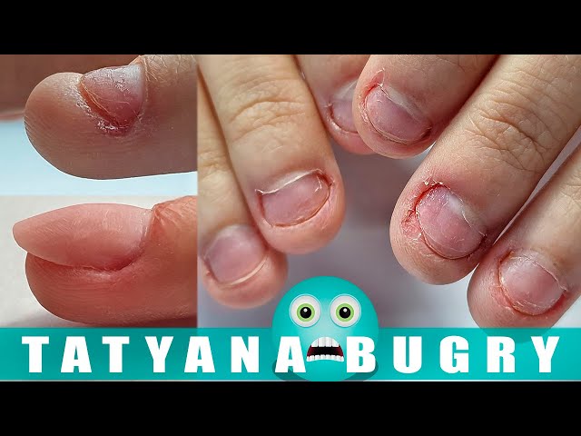 Why do we bite our nails?