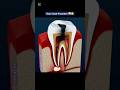 ROOT CANAL THERAPY 🦷😬