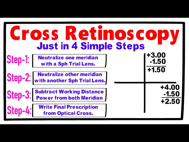 Cross Retinoscopy just in 4 Simple Steps 