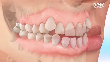 Niềng răng móm như thế nào? #orthodontist #braces