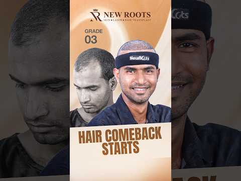 Grade 3 Baldness Hair Transplant | Hair Transplant in Bangladesh | Bangla #hairtransplant #shorts