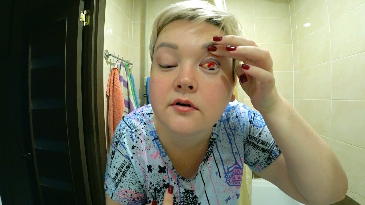 Я в ПАНИКЕ, ЭКСТРЕННО иду на приём к ВРАЧУ! Глаз залило КРОВЬЮ после ...