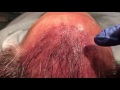 Dallas Hair Transplant Recipient Sites in a Megasession