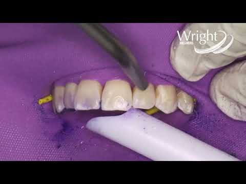 Video: Dental Hypoplasi: Behandling, Orsaker, Foton, Former