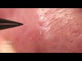 鼻角栓123 nose blackheads★tweezers only★