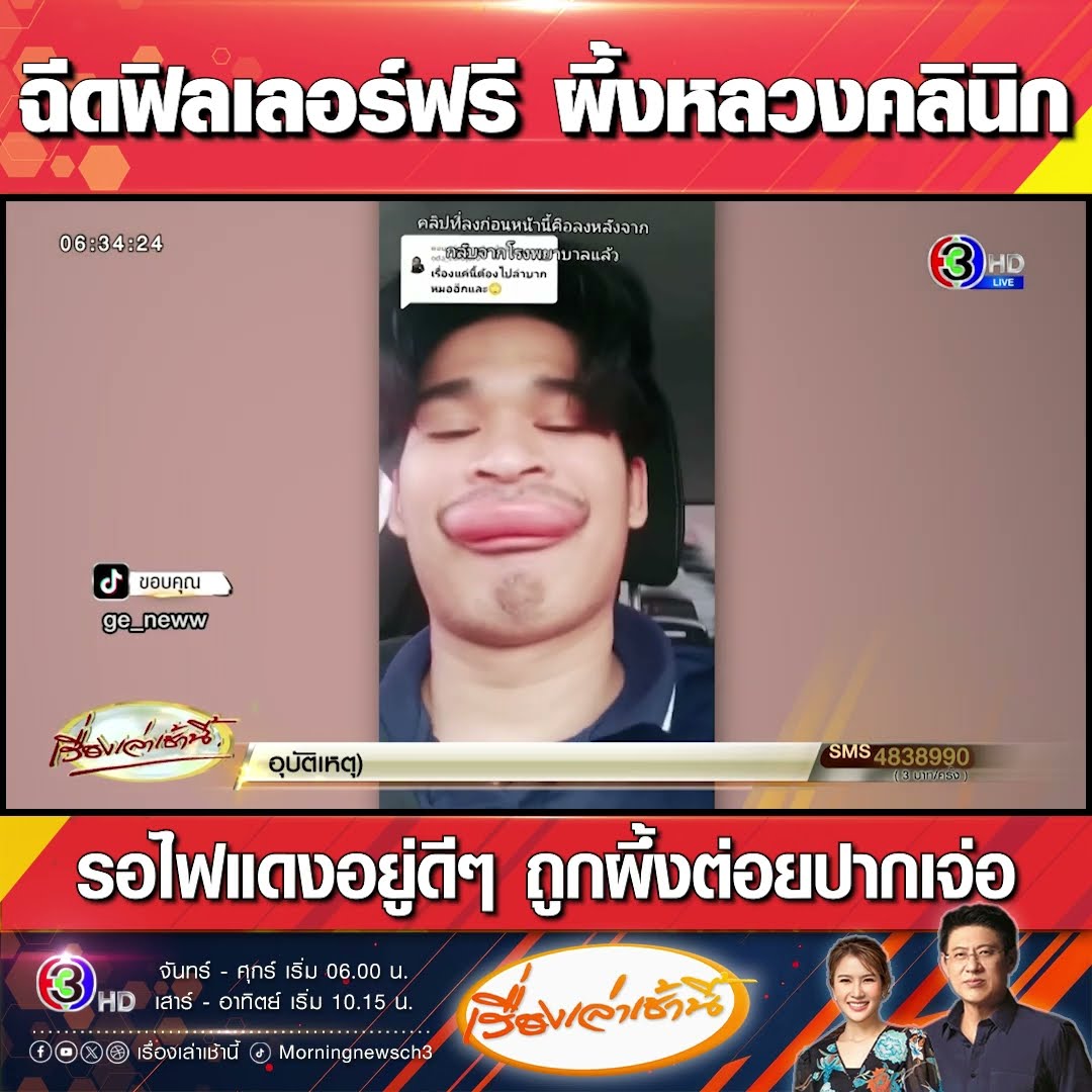 ฉีดฟิลเลอร์ฟรี ผึ้งหลวงคลินิก รอไฟแดงอยู่ดีๆ ถูกผึ้งต่อยปากเจ่อ