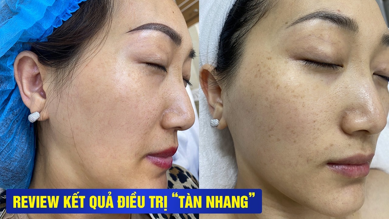 Kết quả chỉ sau 1 buổi điều trị bằng công nghệ ALMA-Q, Tàn nhang của chị đã cải thiện đến 70%.